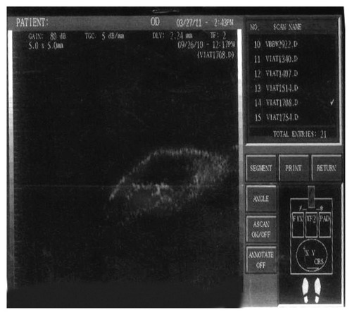 Figure 7 Ultrasonic biomicroscopy image for low reflectivity in a case of the group with mitomycin C (group B).