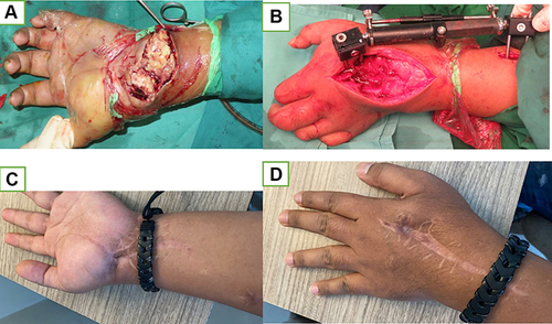 Figure 5 (A) Casseous necrosis was found in the volar side of patient in Figure 3; (B) External fixator span the wrist joint; (C and D) 1 year post operative.