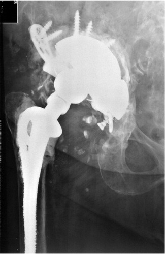 Figure 5. 6 months after re-revision of the acetabular components. A modified jumbo Ta cup-Ti cage construct and peripheral Ta augment were used due to pelvic discontinuity. The patient had no pain at the latest follow-up.