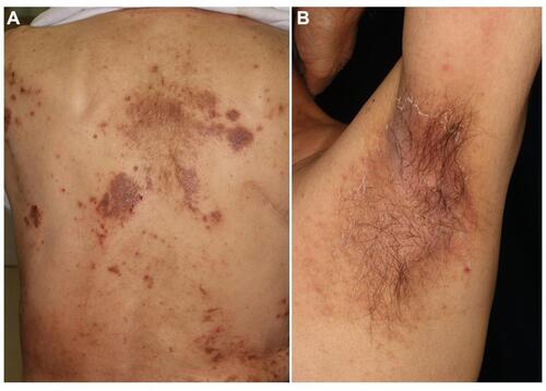 Figure 1 (A) Nummular eczema on the back under nivolumab therapy. (B) Seborrheic dermatitis in the axilla under nivolumab therapy.