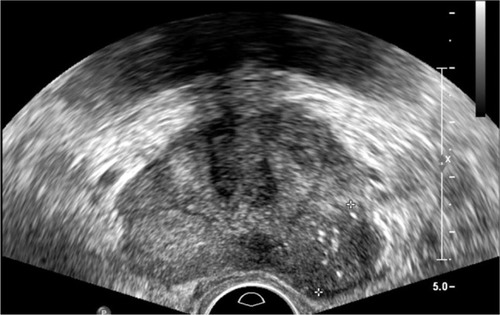 Figure 1 Suspicious lesion on TRUS (rim margin marked by cross).Abbreviation: TRUS, transrectal ultrasound.