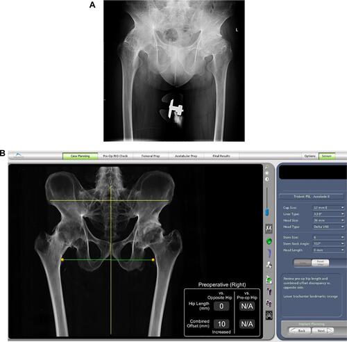 Figure 1 Preoperative X-rays and three-dimensional model construction of the arthrodesed hip. (A) Preoperative anteroposterior X-rays of bilateral hips. (B) Three-dimensional model construction of pelvis in the robotic system.