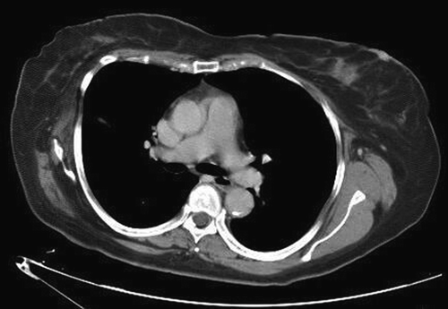 Figure 5.  CT scan demonstrating relapse in bilateral lungs and breasts.