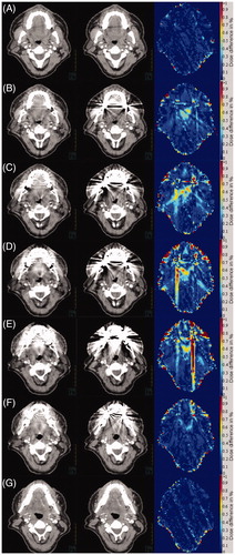 Figure 2. (A–G) Slices of Patient 7 reconstructed with and without the O-MAR filter are shown in the left and middle column. The right column shows the absolute dose difference in percent of the prescribed dose (66 Gy). In (A) only at very small artifact reduction is seen and therefore only very small dose differences are observed. In (B–E) large artifact reductions are seen, which also translates in to large local dose differences, though still mainly below 1%. In (F), the dose difference is small compared to the large artifact reduction. The dose differences observed are mainly located very close to the metal artifacts or at the skin of the patient. In (G), the standard and O-MAR CT slices are the identical. However, there is a small difference in the two dose cubes caused by the metal artifacts in the surrounding CT slices.
