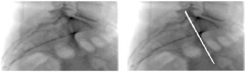 Figure 2. A blank DRR after realigning the CT data (l) and a DRR based on realigned CT data on which the anterior iliac surface just lateral to the SIJ has been highlighted on the left and right side (r).