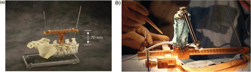 Figure 3. Attachment to bony anatomy. (a) Clamp and bridge. (b) Minimally invasive Hover-T.