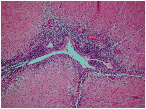 Figure 3. Histological image of the resected specimen showing signs of endometriosis and fibrosis (hematoxylin-eosin).