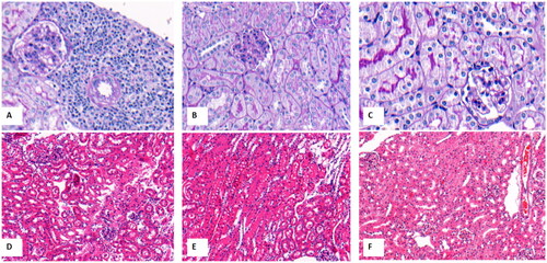 Figure 2. The representative pathological changes of MRL/lpr mice and C57 mice. A, AKI mice with endocapillary proliferation and interstitial inflammation in vehicle group (PAS staining, ×200); B, noAKI mice with endocapillary proliferation in vehicle group(PAS staining, ×200); C, C57 mice with normal renal pathological changes(PAS staining, ×200); D, AKI mice with endocapillary proliferation and interstitial inflammation in vehicle group (H&E staining, ×100); E, noAKI mice with endocapillary proliferation in vehicle group (H&E staining, ×100); F, C57 mice with normal renal pathological changes (H&E staining, ×100).