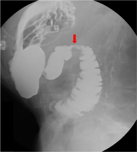 Figure 3 Upper gastrointestinal series. Impression of the third part of the duodenum suggestive of superior mesenteric artery syndrome (red arrow).
