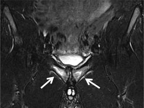 Figure 3 Coronal T2 fat suppression MRI image showing marked bilateral diffuse symphyseal bone marrow edema and parasymphyseal edema (arrows).