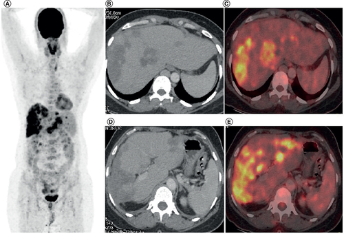Figure 2. Fluorodeoxyglucose-positron emission tomography images of a 49-year-old female patient of metastatic hepatic epithelioid hemangioendothelioma.This scan represents the radiological findings prior to initiation of pazopanib-based therapy for this patient. (A) MIP image FDG PET-CT showing increased tracer uptake in the hepatic region. (B & D) Axial CT abdomen showing confluent hypodense lesions in both the lobes of liver. (C & E) There is increased tracer uptake noted at the liver lesions in the fused PET-CT images.MIP: Maximum intensity projection.