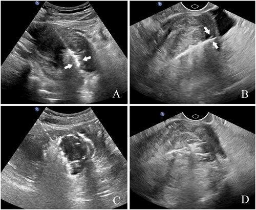 Figure 2. TA/TV US-guided PMWA for the treatment of UM. A. TAU disturbed by strong echo, in which the needle tip is not clearly displayed (white arrow). B. TVU is not disturbed by strong echo, with clear display of the needle tip (white arrow). C. The strong echo generated by ablation under TAU monitoring interferes with the display of the posterior tissue. D. Clear display of the posterior tissue and part of uterine serosa in TVU monitoring. TA/TV: combined transabdominal and transvaginal; US: ultrasound; PMWA: percutaneous microwave ablation; UM: uterine myoma; TAU: transabdominal ultrasound; TVU: transvaginal ultrasound