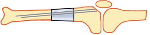 Figure 3. Schematic illustration of positioning and fixation of the implant into the rabbit tibia.
