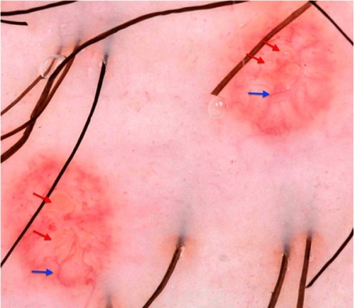 Figure 3 Dermatoscopic findings of MC. Red arrows: white-to-yellow polylobular structures. Blue arrows: crown vessels. (Polarized-light dermoscopy, original magnification 10×).