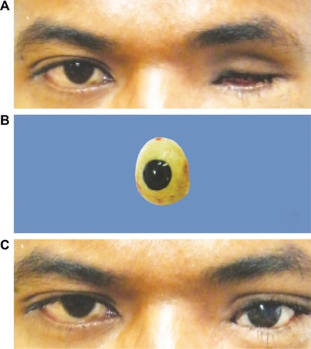 Figure 2 (A) Before the eye prosthesis wearing, a 25-year-old male who underwent evisceration with nonporous implant. He could not wear the eye prosthesis because of volume insufficiency. After that he underwent the secondary dermis-fat graft. (B) The custom-made eye prosthesis. (C) After the eye prosthesis wearing at 2.8-year-postoperative dermis-fat graft.