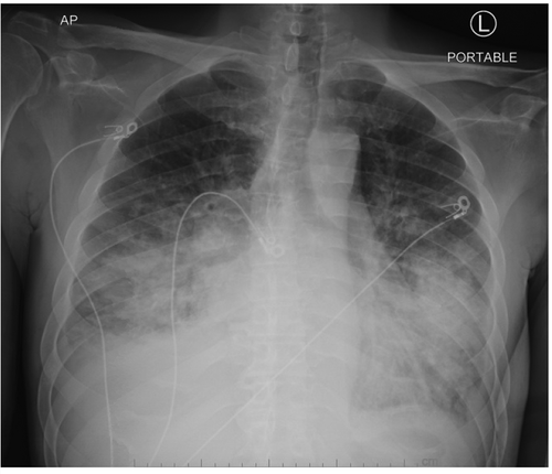 Figure 2. Chest X-ray above shows central vascular prominence with abnormal alveolar opacities in the mid and lower lungs bilaterally in addition to small effusions