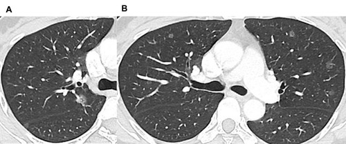 Figure 1 Images of a 48-year-old female tyrosine kinase inhibitor (TKI)-naive patient with T790M mutation-positive non-small-cell lung cancer (NSCLC). (A) Computed tomography (CT) image in the axial lung window setting showing a 1.2-cm lung nodule in the right upper lobe under the horizontal fissure, with an internal air bronchogram. (B) Axial CT image showing multiple ground-glass nodules in the bilateral lungs.