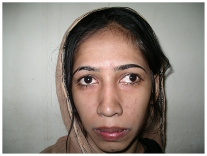 Figure 3 A 16-year-old girl with left eye concomitant strabismus.