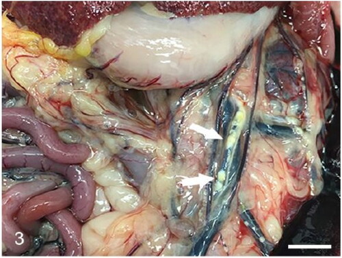 Figure 3. Case 3. The short gastric arteries are expanded by multifocal pale-yellow (atheromatous) plaques (arrows).