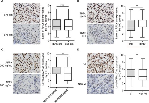 Figure 2 Protein expression of RALY in HCC tissues of different tumor sizes, TNM stages, AFP levels, and conditions of vascular invasion determined by immunohistochemistry (IHC).Notes: (A) The difference of the expression of RALY in HCC tissues with TS >5 cm and in HCC tissues with TS ≤5 cm was not significant (P=0.092). (B) The expression of RALY in HCC tissues with later TNM stages (III + IV) was significantly higher than that in HCC tissues with earlier TNM stages (I+II) (P=0.002). (C) The expression of RALY in HCC tissues with higher AFP levels (>200 ng/mL) was significantly higher than that in HCC tissues with lower AFP levels (≤200 ng/mL) (P=0.007). (D) The expression of RALY in HCC tissues without VI was significantly lower than that in HCC tissues with VI (P=0.006). The boxes represent the 25th to 75th percentiles of the observations, and the medians are indicated by the lines in the middle of the box. The scale bars indicate 25 µm. **P<0.01; NS represents no significant difference.Abbreviations: HCC, hepatocellular carcinoma; TS, tumor size; VI, vascular invasion.