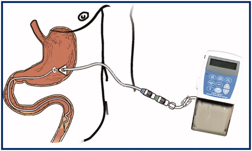 Figure 2. Infusion system for levodopa/carbidopa intestinal gel.