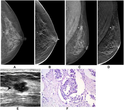 Figure 2 Images of a 61 years-old female patient with grade II invasive ductal carcinoma on the left breast. (A) CC-FFDM shows isometric irregular mass on the lateral side of left breast central area (white arrow). (B) CC-DBT shows spiculate mass (white arrow). (C) MLO-FFDM shows irregular mass on upper left breast with unclear border (white arrow). (D) MLO-DBT shows mass with spiculated margins (white arrow). (E) Ultrasound shows lobulated hypoechoic mass on the left breast (black arrow), located in the 2 o’clock direction. (F) 100×HE staining shows cancer cells growing in a nested invasion pattern with abnormal cell shape.