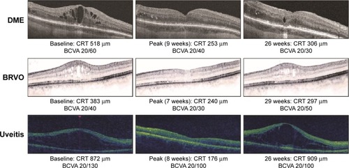 Figure 4 OCT retinal images from representative DME, BRVO, and uveitis study eyes at baseline and after treatment with the DEX implant. BCVA and CRT by OCT are indicated.