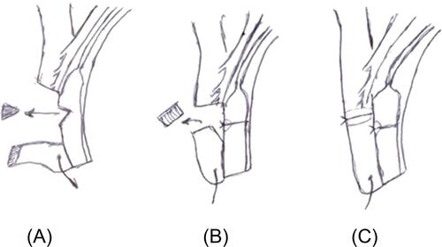 Figure 2 Lamellar tarsectomy procedure: (A) The pretarsal orbicularis fibers and the anterior fibers of the muscle of Riolan were divided till visualization of the external surface of the tarsus. Two lines in tarsal surface in a distance 2–3 mm in between were marked with superblade 30 degrees (MANI-MST-30), deep incisions. (B) D-shaped lamellar incision of external surface of tarsus was made to remove the superficial lamella of tarsus with groove formation. (C) Three 6/0 Coated VICRYL stitches were taken from the peripheral incision line to the anterior incision line without cutting the tarsus. As the sutures were tied, the lid margin might rotate outward, causing the lashes to rotate externally away from the cornea.