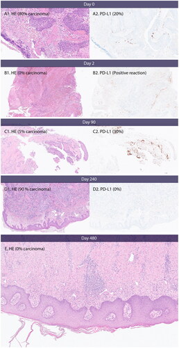Figure 4. PD-L1 expression, necrosis and inflammation. (A) Day 0, baseline before first CaEP treatment. A1 shows carcinoma with necrosis and inflammation. (B) Day 2, after one CaEP treatment. B1 shows necrosis and inflammation. (C) Day 90, before second CaEP treatment. C1 shows pronounced inflammation and no necrosis. C2 shows PD-L1 expression of tumour tissue. (D) Day 240, before third CaEP treatment. D1 shows a biopsy from a recurrence with low inflammation of tumour tissue and no PD-L1 expression. (E) Biopsy from clinical complete response two months after fourth CaEP treatmen. E shows inflammation and fibrosis and no residual tumour.