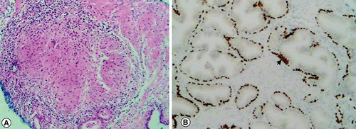 Figure 3. Histopathological findings of in-bore prostate biopsy.(A) Hematoxylin and eosin staining showing a non-necrotizing granuloma composed of epithelioid histiocytes and giant cells. (B) Immunochemistry highlighting normal prostatic glands with positive p63 basal cells (arrowhead), not in favor of prostate cancer.