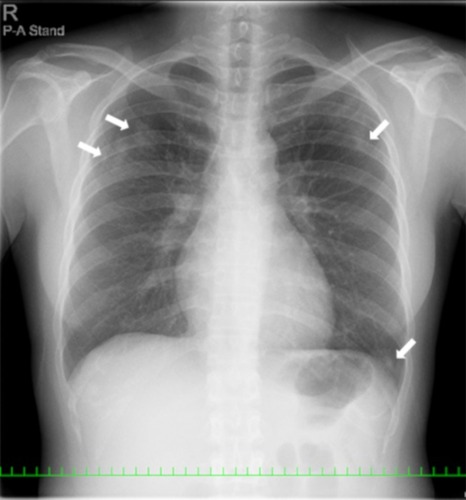 Figure 1 A chest X-ray revealed patchy consolidation in the bilateral upper and left lower lung field (white arrow).