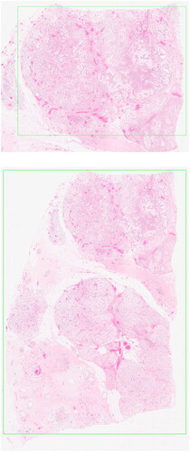 Figure 2. Histology slides with hematoxylin & eosin staining of myxoid fibroadenoma.