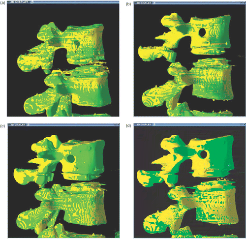 Figure 4. Three-dimensional isosurface displays after registration of L4. (a) A case with no movement of L3, showing “zebra” pattern between the reference (yellow) and transformed vertebrae (green) in both L4 and L3. A disc prosthesis is incorporated between the vertebrae for future studies. (b) A 0.5-mm sagittal translation of L5. (c) A 1.0-mm sagittal translation of L3. (d) A 2.0-mm sagittal translation of L3. [Color version available online.]