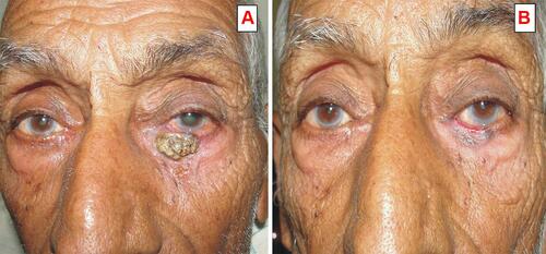 Figure 1 (A) Pre chemotherapy photograph of a 70 years old male patient having left lower eyelid ulceronodular type sebaceous gland carcinoma. (B) After 3 cycles of neoadjuvant chemotherapy (cis-platinum and 5 FU), showing partial response of chemotherapy.