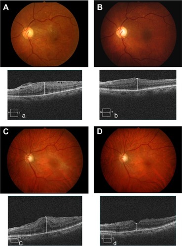 Figure 3 Fundus photography (A and B), and horizontal optical coherence tomography (OCT) macular scans (a and b) before and 1 month after vitrectomy and removal of epiretinal membrane (nontreatment). Fundus photography (C and D), and horizontal OCT macular scans (c and d) before and 1 month after vitrectomy and removal of epiretinal membrane (dorzolamide treatment).