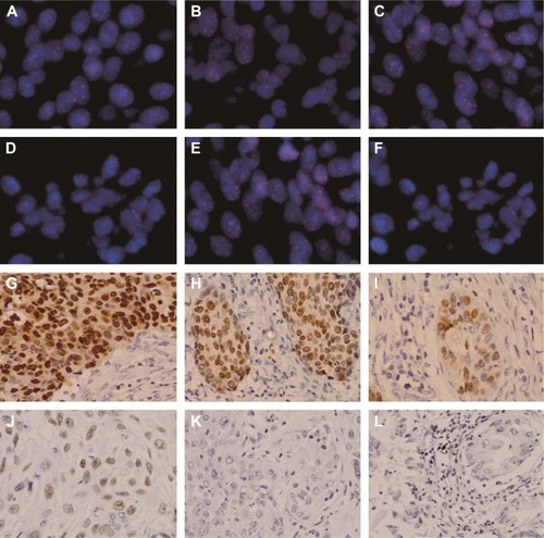 Figure 1 Representative images of fluorescence in situ hybridization and immunohistochemistry for SOX2 in lung squamous cell carcinoma samples.