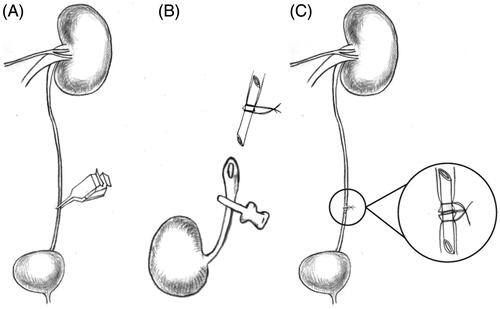 Figure 1. Schematic diagram of the ureteral anastomosis procedure with polyimide stent placement. (A) The left ureter was blocked for 1-h to induce dilatation of the ureter. (B) The stent was placed into the left ureter and tied with a 11-0 silk suture. (C) The three ligatures were tied together.