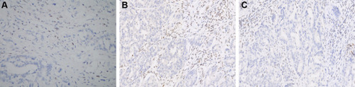 Figure 2 Immunohistochemical analysis of the two dMMR patients. (A) MLH1-negative (case 1); (B) and (C) MLH1 and PMS2-negative (case 2). Magnification: × 200.