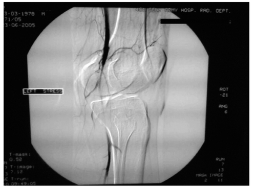 Figure 1 Computed tomographic angiogram findings with left popliteal artery entrapment syndrome.