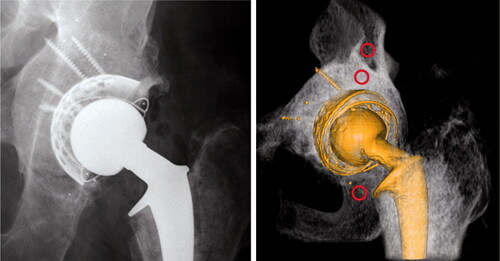 Figure 1. Postoperative images. Note the greater density in the bone graft compared with native bone. The 3 red circles indicate the ROIs of the bone mineral density measurements.