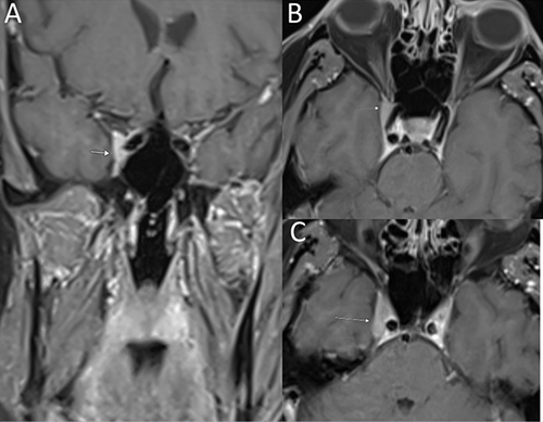 Figure 1 57-year-old man with multiple cranial neuropathies. Coronal (A) and axial (B and C) contrast-enhanced T1-weighted MR images showing a nodular enhancing lesion within the anterior right cavernous sinus (arrows) (B-cell lymphoma on biopsy).