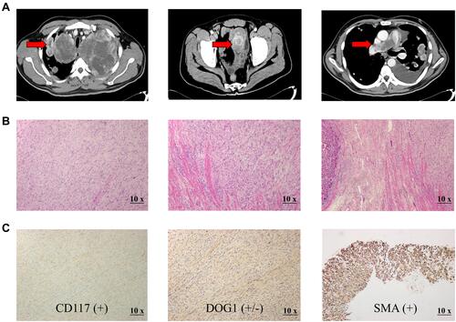 Figure 1 Preoperative Contrast-enhanced CT images and postoperative histology examination of the LGMS specimen. (A). CT images at the initial diagnosis (the lesions are indicated by arrows). (B). The LGMS tumor cells are mainly in a fascicular arrangement, infiltrative growth with unclear boundaries, with light to moderate heteromorphic and mitotic image (magnification, ×10). (C). Immunohistochemical examination shows positive staining for CD117, DOG1 and SMA (magnification, ×10).