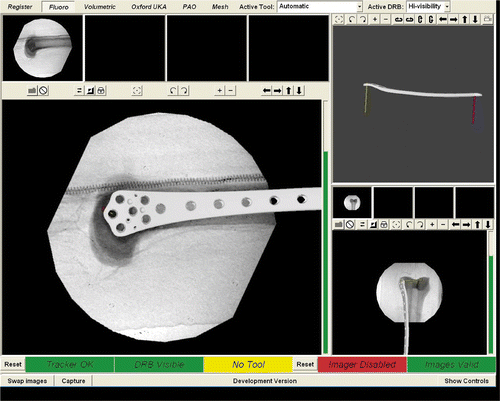 Figure 3. The LISS plate superimposed on the fluoroscopic image of the model femur.