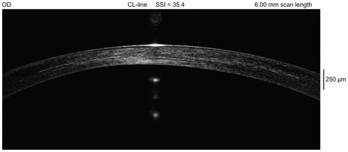 Figure 3 A 1 year postoperative cornea OCT from a case from Group A (also studied in Figure 1). There is very wide and deep stromal hyper-reflectivity representing effective large stromal volume cross-linking.