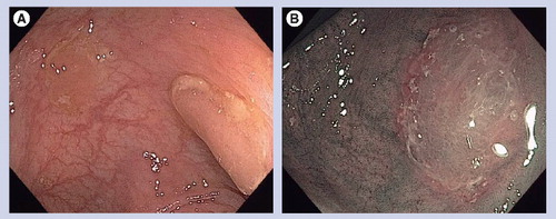 Figure 2. Endoscopic photographs of serrated lesions in the colon.(A) White light photograph of two serrated lesions in the transverse colon. Note the mucus covering on the lesions. The color is similar to the surrounding mucosa, and the lesion obscures the vascular pattern of the normal colon. (B) Narrow-band imaging photograph of a serrated lesion. The mucus cap has a pink colon.
