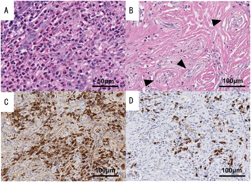 Figure 2. Pathological findings of resected specimens of case 1. The presence of onion skin fibrosis (black triangles) and clustered eosinophils supported the diagnosis of eosinophilic angiocentric fibrosis (EAF). However, the IgG4:IgG ratio in plasma cells was less than 40%. (A) Hematoxylin and eosin stain (high-power field). (B) Hematoxylin and eosin stain (low-power field). (C) IgG immunochemical stain. (D) IgG4 immunochemical stain.