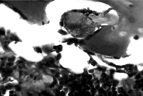 Figure 5. Engulfed polyethylene in macrophages persisting at 4 weeks post-surgery (in femora with rod and UHMWPE particles). Note the characteristic opaque cytoplasm and irregular contours adjacent to scalloped lacunae at the bone-implant interface. HE stain. Magnification: 60 ×.