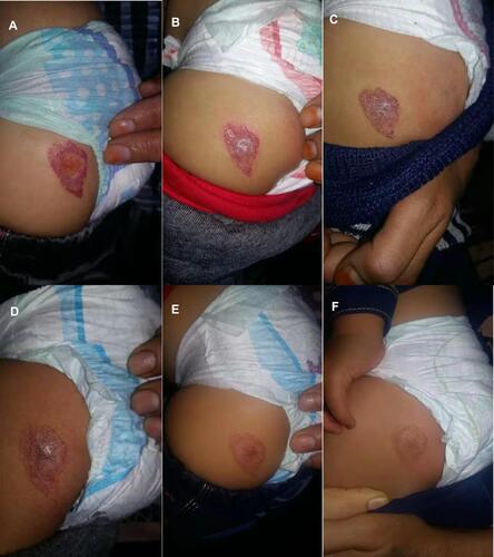 Figure 1 The features of hemangioma during treatment with propranolol at age 6th (A), 8th (B), 10th (C), 12th (D), 14th (E), and 15th (F) months, respectively.