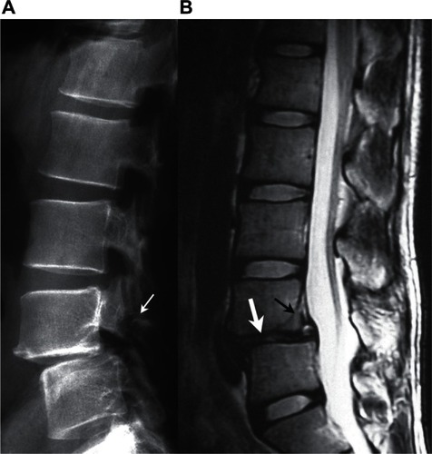 Figure 1 Images 7 months before the onset of pyogenic spondylodiscitis. A) Plain x-ray. Separation of the L4 vertebral arch (small white arrow) and L4/L5 listhesis were noted. B) Plain T2-weighted MRI. The L4/L5 intervertebral disc was degenerated and the height of the intervertebral disc space was decreased (thick white arrow). Separation of ring apophysis of the L4 vertebral body was noted (small black arrow).
