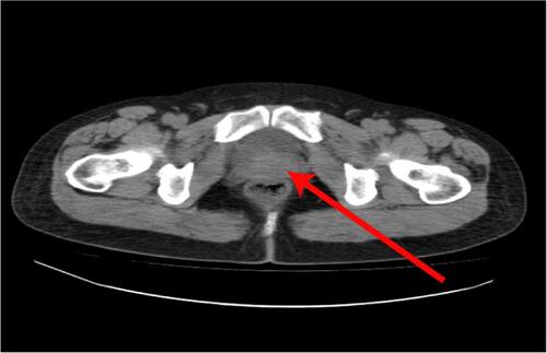 Figure 1 A CT scan of the pelvis showing a mass arising from the posterior wall of the vagina. The tumor mass showed invasion of the posterior vaginal wall without rectal invasion or pelvic floor musculature (red arrow).